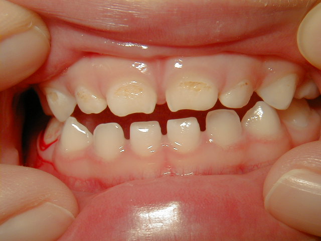 赤ちゃんの歯磨きはいつから？乳歯が虫歯になる原因と虫歯の予防法
